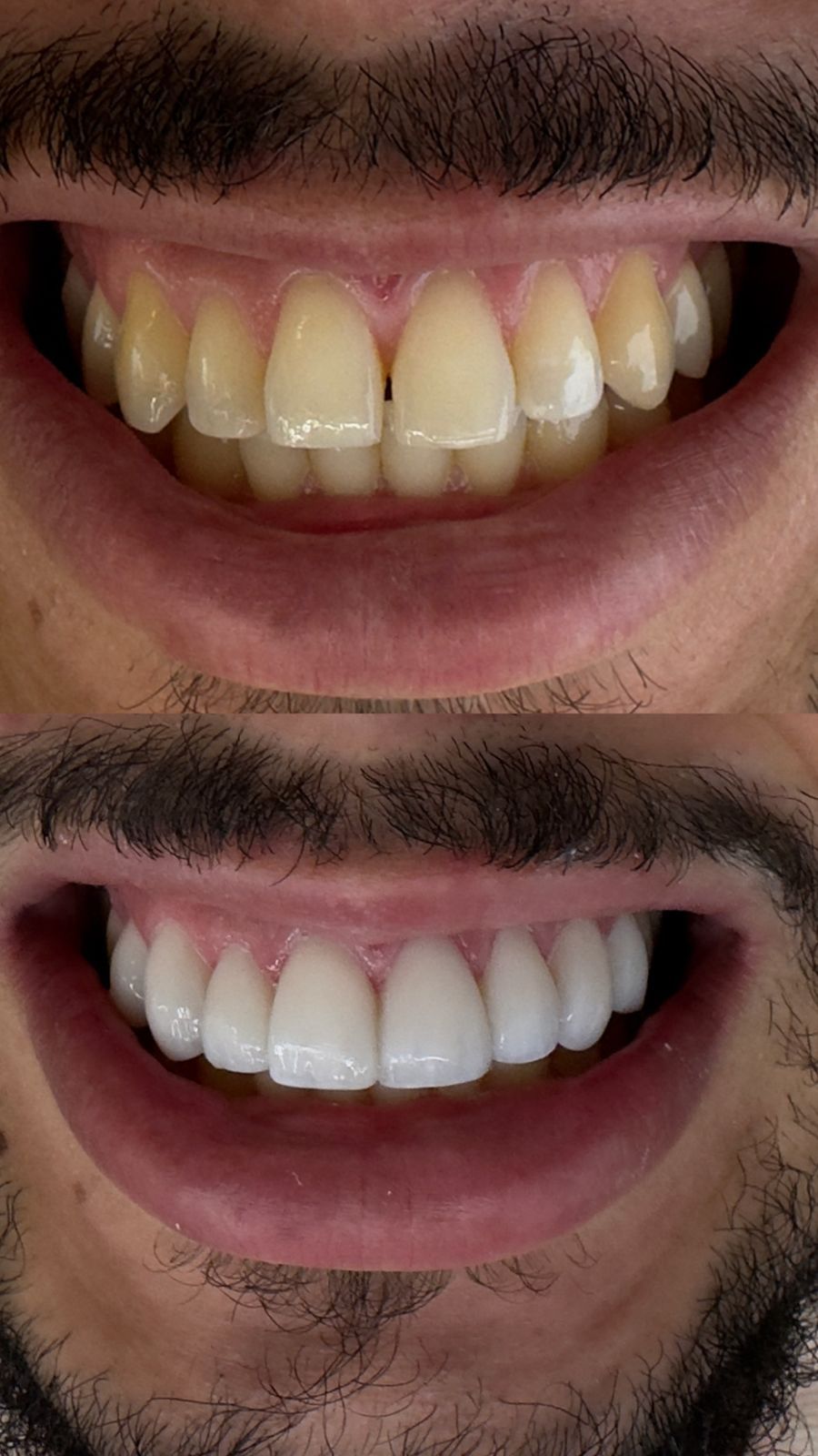 Antes e Depois Clareamento Dental Luanara
