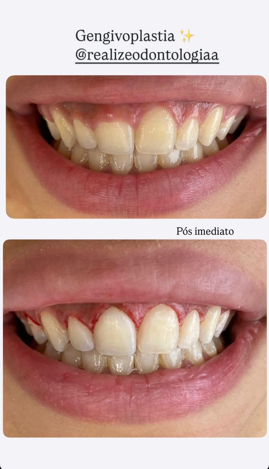 Gengivoplastia Estética